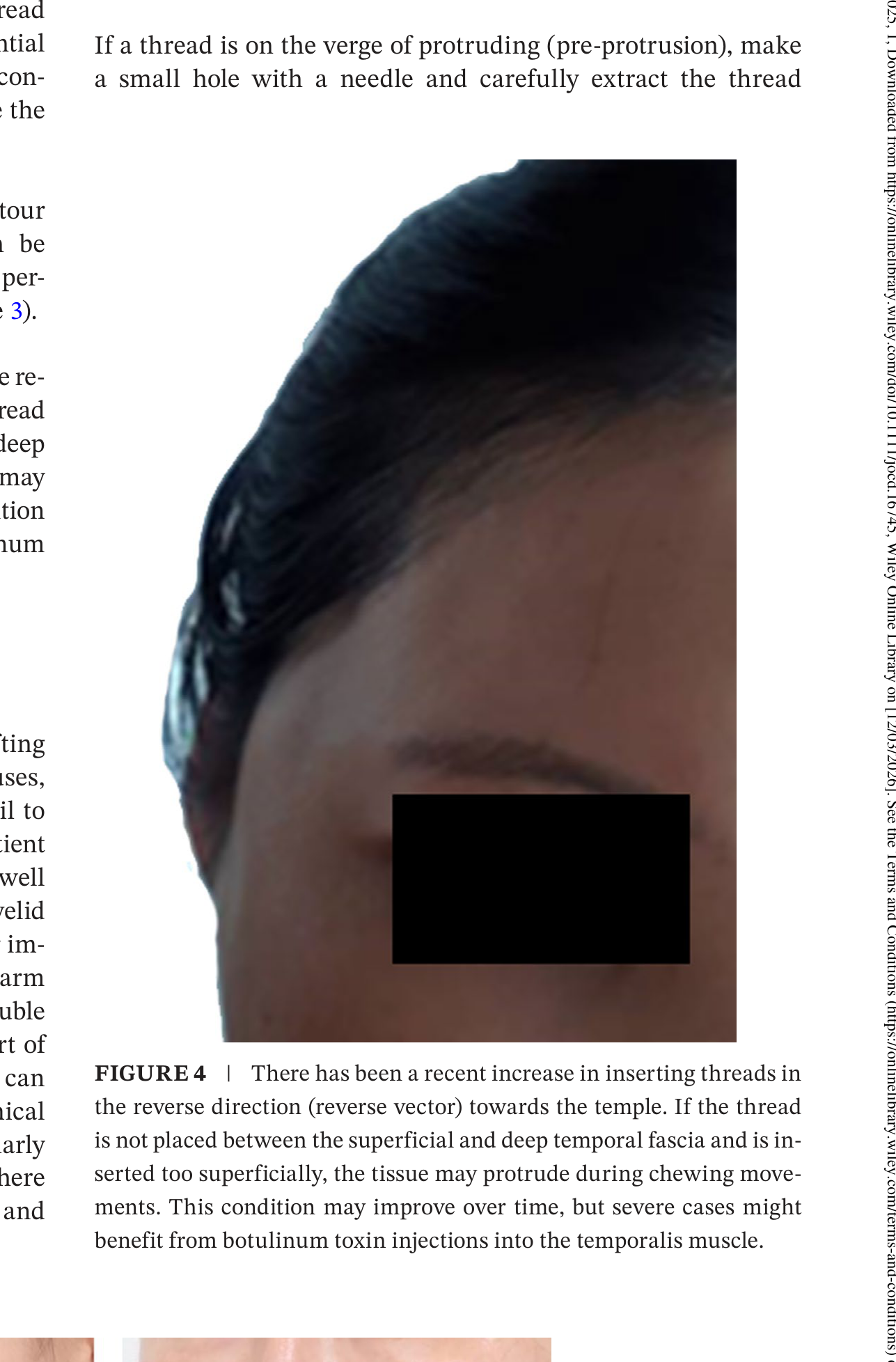 Contour irregularity